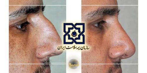 هزینه عمل انحراف بینی با بیمه سلامت