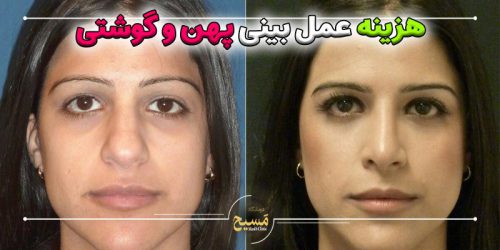 هزینه عمل بینی پهن و گوشتی