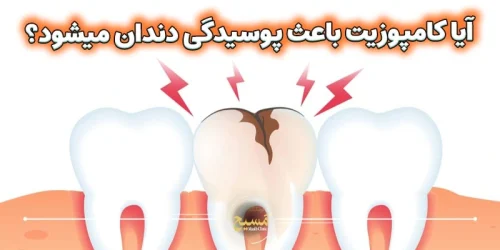 آیا کامپوزیت باعث پوسیدگی دندان میشود؟