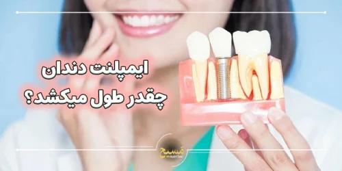 ایمپلنت دندان چقدر طول میکشد؟