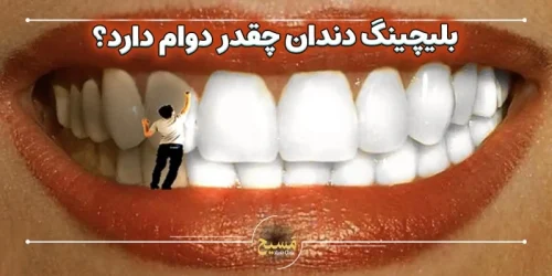 بلیچینگ دندان چقدر دوام دارد؟