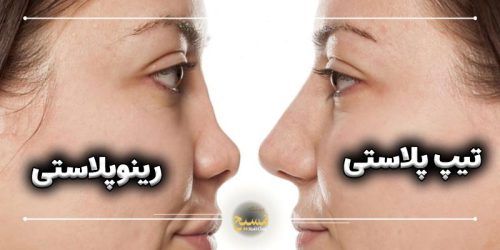 تفاوت جراحی تیپ پلاستی با رینوپلاستی