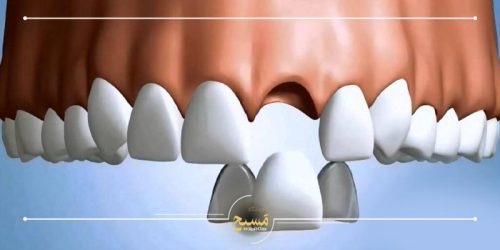 علت افتادن روکش ایمپلنت چیست؟