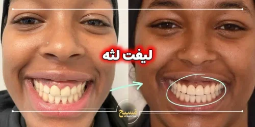 لیفت لثه