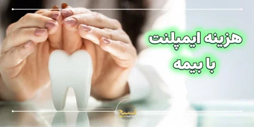 هزینه ایمپلنت دندان با بیمه