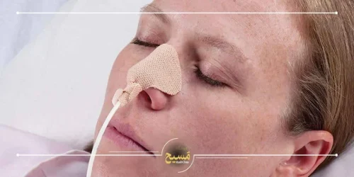 آیا برای عمل بینی سوند وصل می کنند؟