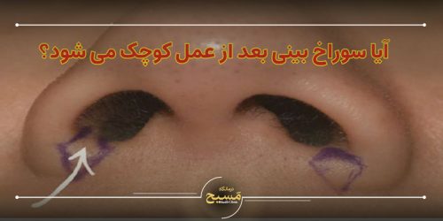 آیا سوراخ بینی بعد از عمل کوچک می شود