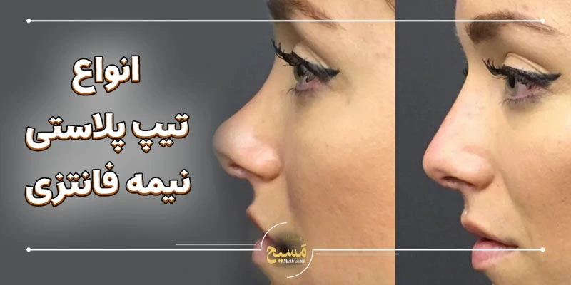 تیپ پلاستی نیمه فانتزی 5 انواع تیپ پلاستی نیمه فانتزی