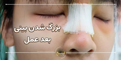 علت بزرگ شدن بینی گوشتی بعد از عمل