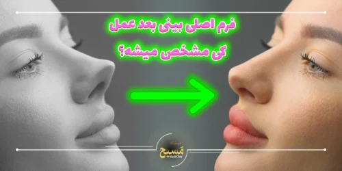 فرم اصلی بینی بعد از عمل کی مشخص می شود؟