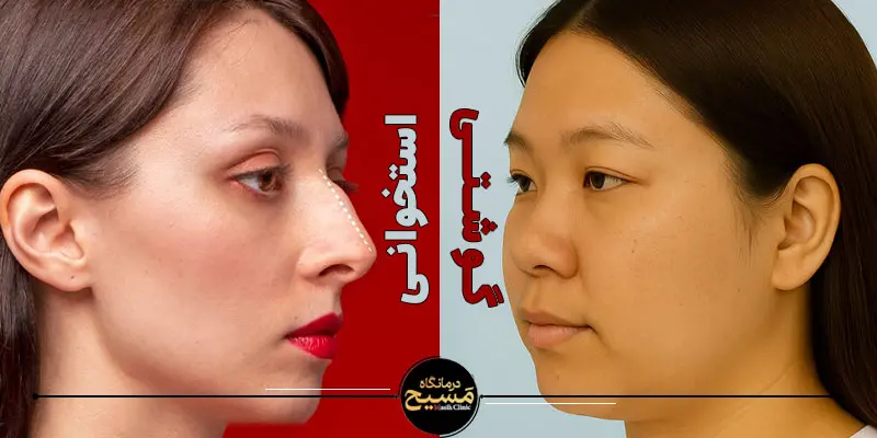عمل بینی گوشتی زنانه طبیعی 1 بینی زنانه گوشتی و استخوانی