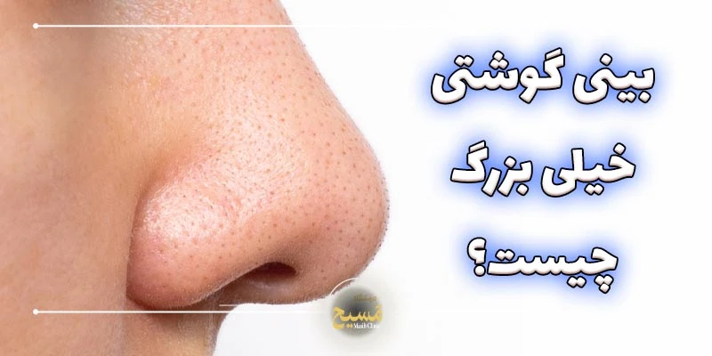 عمل بینی گوشتی خیلی بزرگ 1 بینی گوشتی خیلی بزرگ چیست