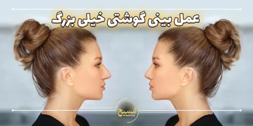 عمل بینی گوشتی خیلی بزرگ