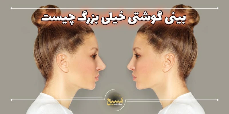 عمل بینی گوشتی خیلی بزرگ 2 عکس قبل و بعد از عمل بینی گوشتی خیلی بزرگ