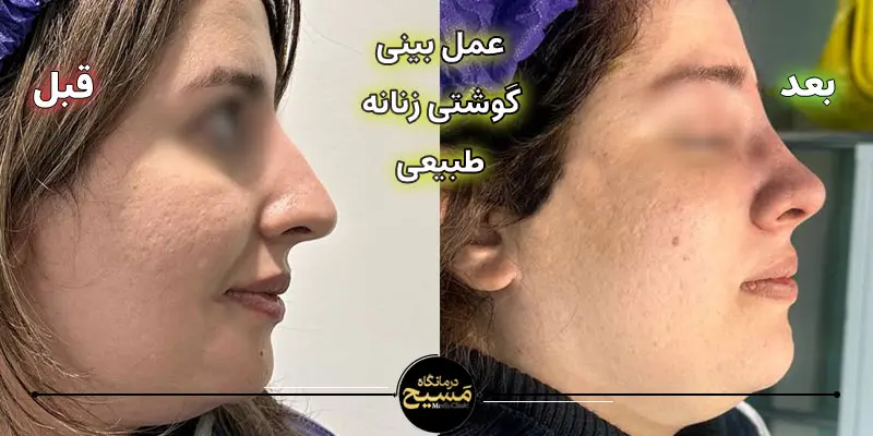 عمل بینی گوشتی زنانه طبیعی 2 قبل و بعد عمل بینی گوشتی زنانه طبیعی
