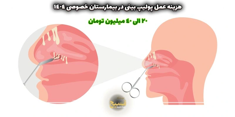 هزینه عمل پولیپ بینی در بیمارستان خصوصی 5 هزینه عمل پولیپ بینی در بیمارستان خصوصی 1404