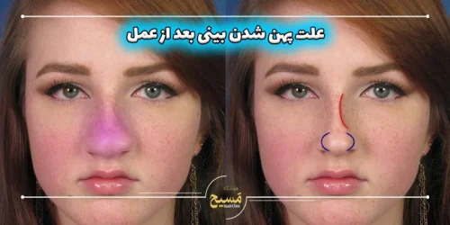علت پهن شدن بینی بعد از عمل