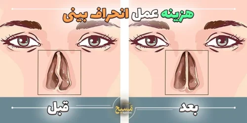 هزینه عمل انحراف بینی