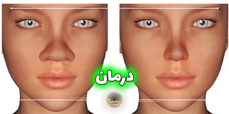 علت پهن شدن بینی بعد از عمل 5 چطور نوک بینی پهن شده بعد از عمل را درمان کنیم؟