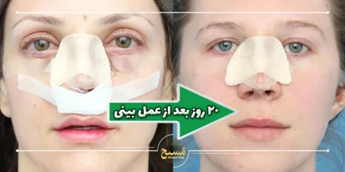 20 روز بعد از عمل بینی
