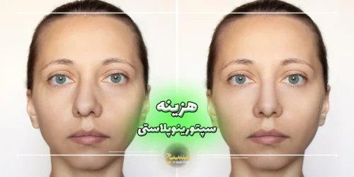 هزینه عمل سپتورینوپلاستی