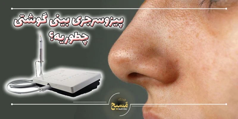 پیزوسرجری بینی گوشتی 1 پیزوسرجری بینی گوشتی چگونه انجام می شود؟