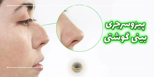 پیزوسرجری بینی گوشتی
