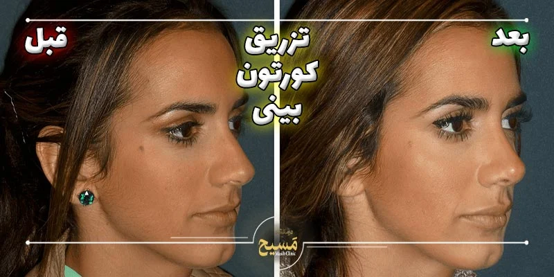 عکس قبل و بعد تزریق کورتون به بینی 9 عکس قبل و بعد تزریق کورتون به بینی