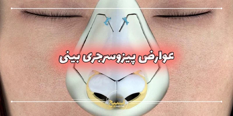عوارض عمل بینی با دستگاه پیزوسرجری 1 عوارض عمل بینی پیزوسرجری