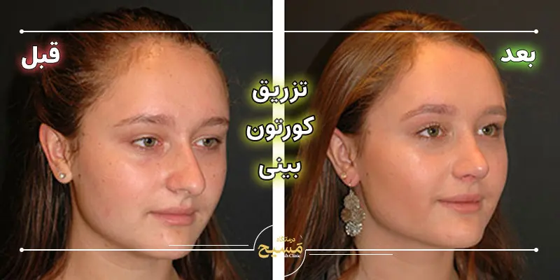 عکس قبل و بعد تزریق کورتون به بینی 1 عکس تزریق کورتون به بینی قبل و بعد