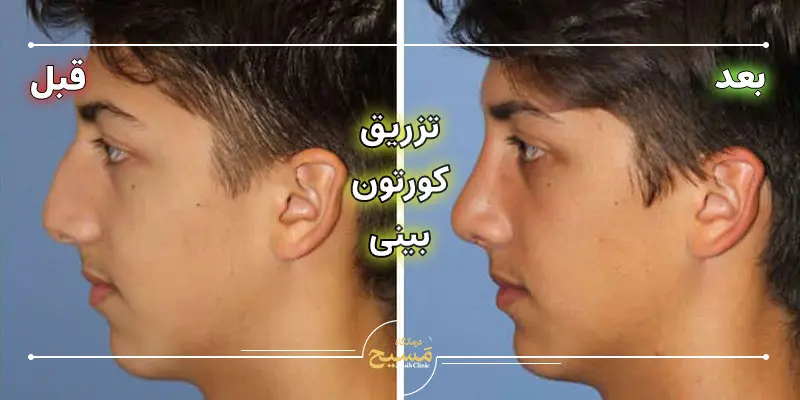 عکس قبل و بعد تزریق کورتون به بینی 2 عکس تزریق کورتون بینی قبل و بعد