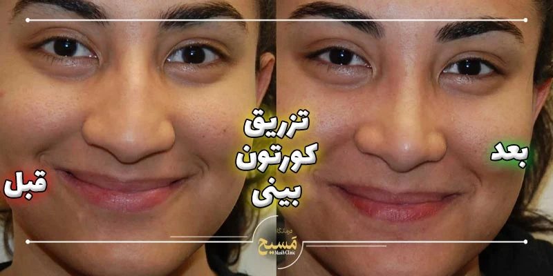 عکس قبل و بعد تزریق کورتون به بینی 7 عکس قبل و بعد تزریق کورتون بعد از عمل بینی