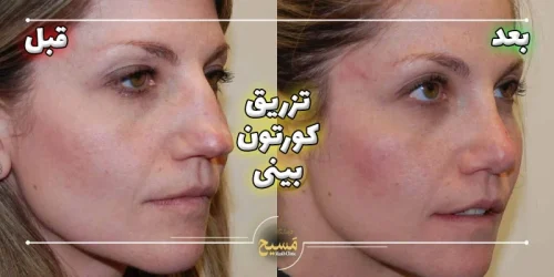 عکس قبل و بعد تزریق کورتون به بینی