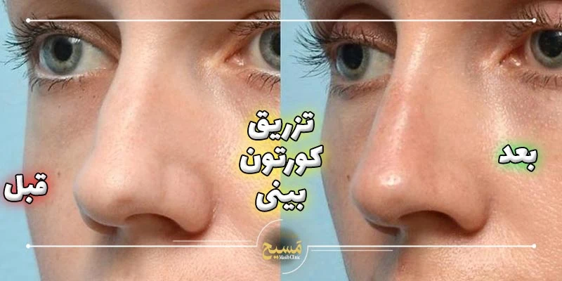 عکس قبل و بعد تزریق کورتون به بینی 6 عکس قبل و بعد تزریق کورتون