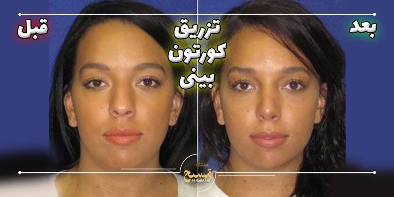 عکس قبل و بعد تزریق کورتون به بینی 4 عکس قبل و بعد زدن کورتون به بینی
