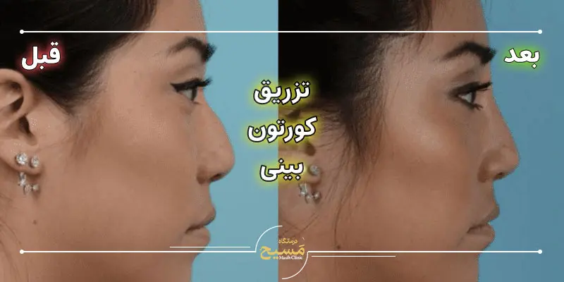 عکس قبل و بعد تزریق کورتون به بینی 3 عکس کورتون زدن به بینی قبل و بعد