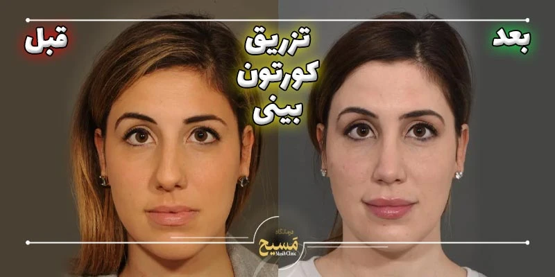 عکس قبل و بعد تزریق کورتون به بینی 5 قبل و بعد تزریق کورتون به بینی