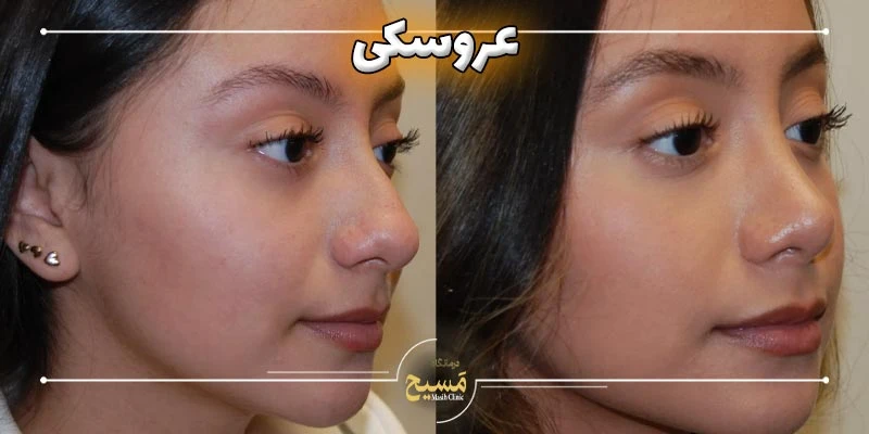 نیمه فانتزی مدل بینی عروسکی 2 مدل بینی عروسکی چیست؟