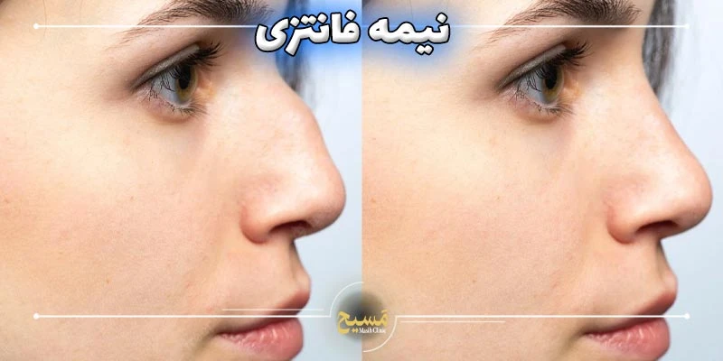 نیمه فانتزی مدل بینی عروسکی 1 مدل بینی نیمه فانتزی چیست؟