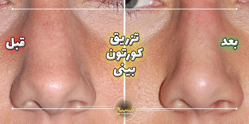 عکس قبل و بعد تزریق کورتون به بینی 8 نمونه کار تزریق کورتون به بینی