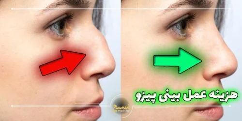 هزینه عمل بینی پیزو