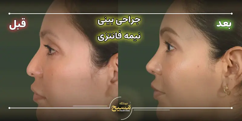 بینی نیمه فانتزی 3 عمل بینی نیمه فانتزی عکس قبل و بعد