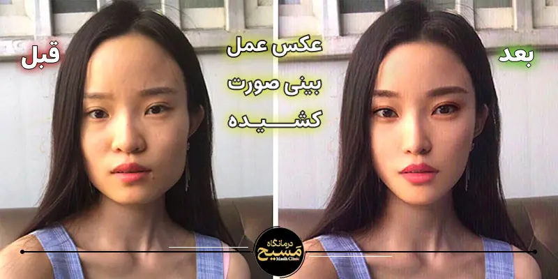 بینی عروسکی برای صورت کشیده 6 عکس عمل بینی صورت کشیده