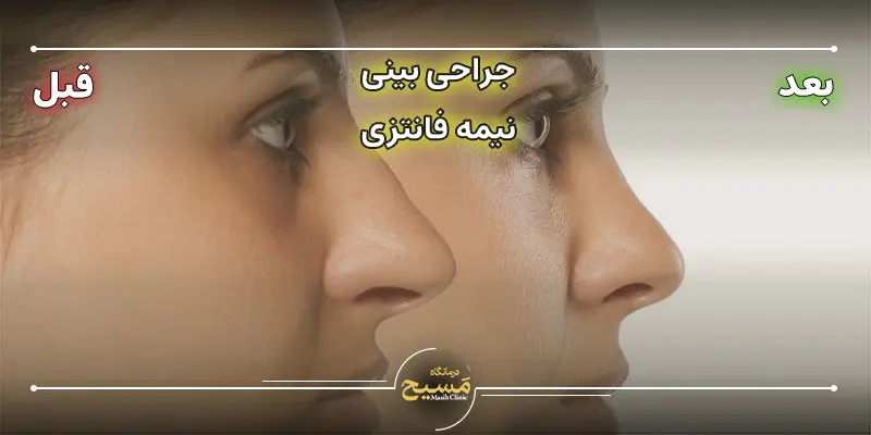 بینی نیمه فانتزی 1 عکس قبل و بعد جراحی بینی نیمه فانتزی