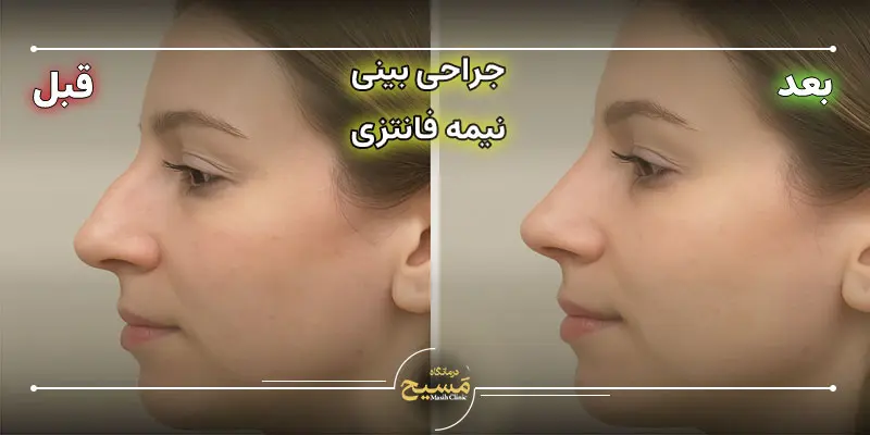 بینی نیمه فانتزی 2 عکس قبل و بعد عمل بینی نیمه فانتزی
