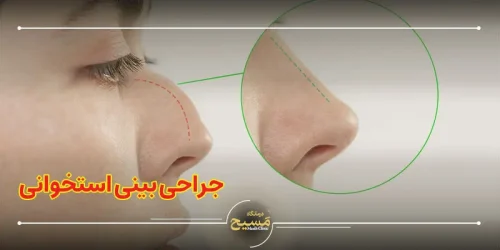 جراحی بینی استخوانی
