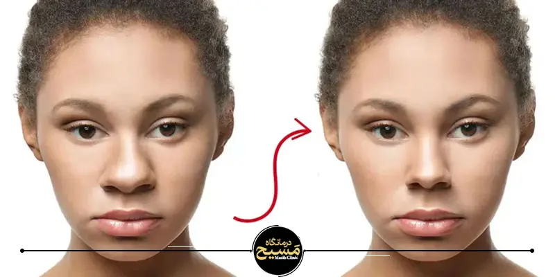 بینی نیمه فانتزی به چه صورت هایی میاد؟ 5 عمل بینی نیمه فانتزی نوک گرد