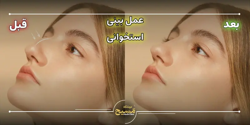 بهترین مدل عمل بینی استخوانی 1 عکس قبل و بعد عمل بینی استخوانی