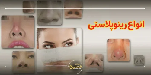 انواع رینوپلاستی