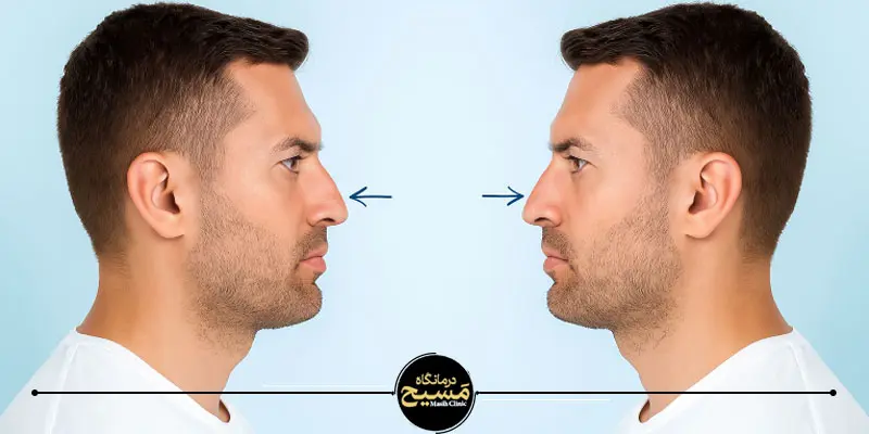 مدل های بینی ترند 1404 3 بینی با قوز ملایم ترند 1404